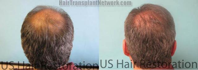 Back view before and after hair transplantation photos