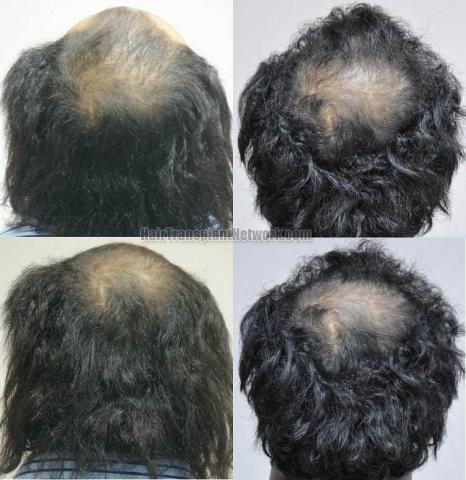 Hair transplantation surgery before and after pictures