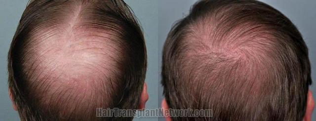 Hair transplantation surgery before and after photos