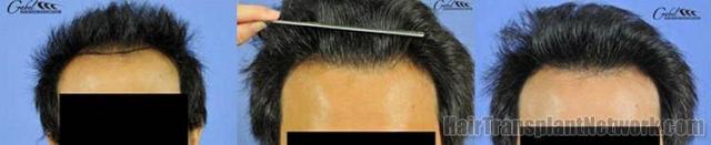 Front view - Hair restoration procedure results