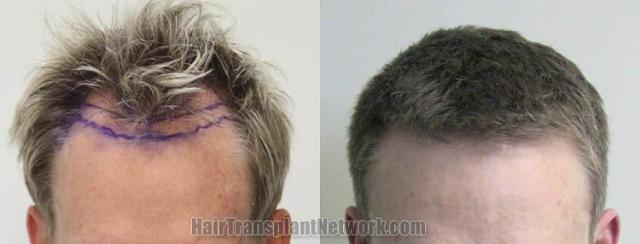 Hair restoration procedure before and after results