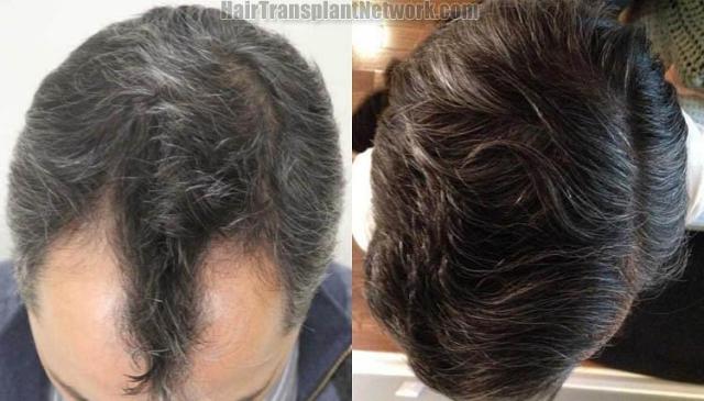 Hair transplantation surgery before and after photos