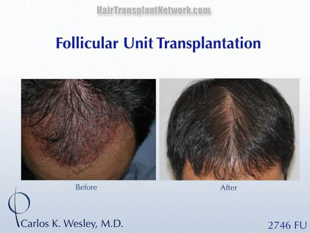 Hair restoration procedure before and after pictures