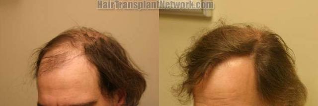 Left  view before and after hair transplantation pictures