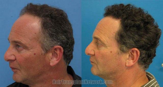 Hair restoration procedure results