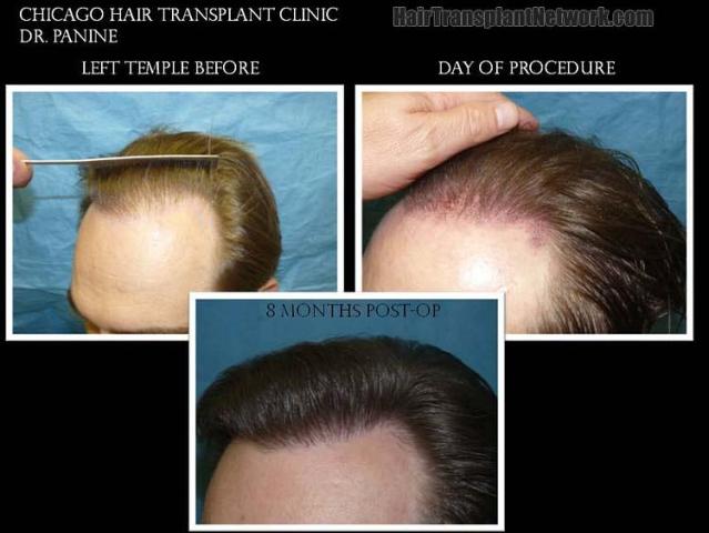 Hair restoration procedure before and after pictures