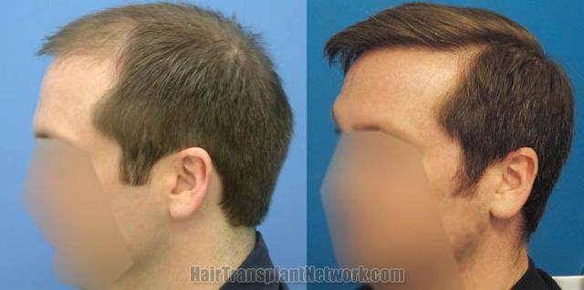 Hair transplantation surgery before and after images