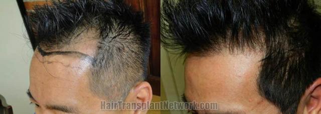 Dr John Diep Hair Restoration Surgery Before And After Result Images