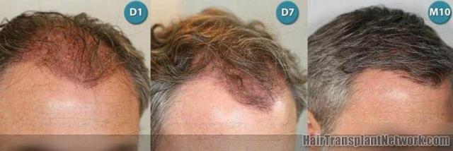 Right photos showing hair replacement surgery photos