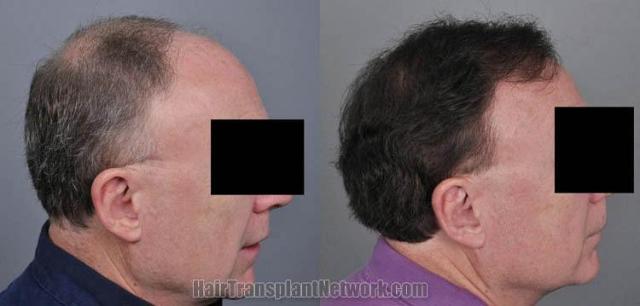 Hair transplantation surgery before and after images