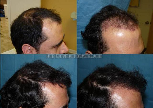 Before and after hair transplantation surgery images