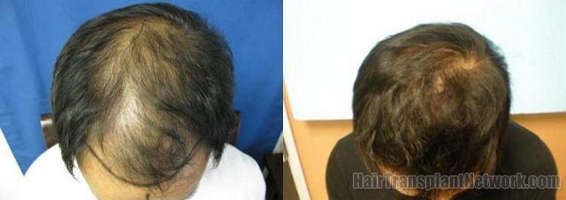 1742 grafts hair restoration results