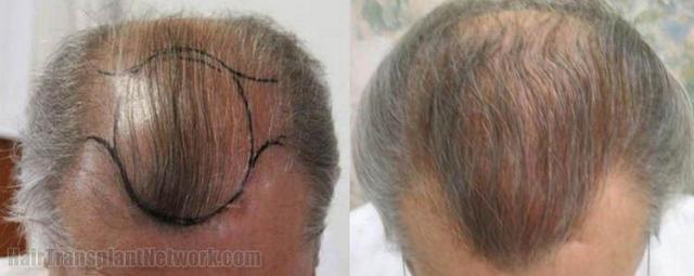 Top view of hair restoration results
