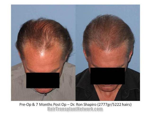 Top view pictures before and after hair restoration