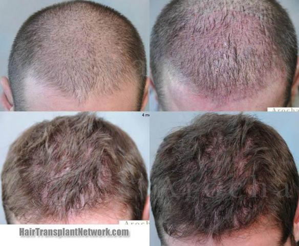 Hair restoration procedure before and after results