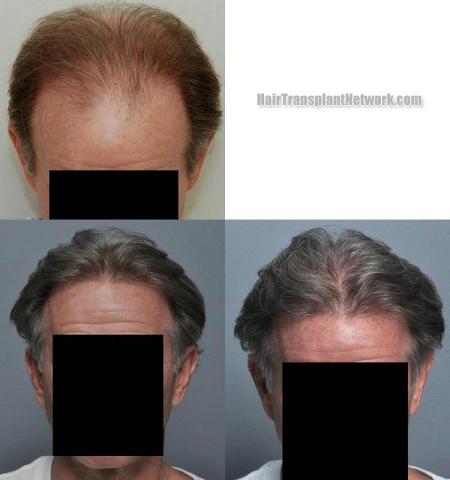 Hair transplantation surgery before and after photos