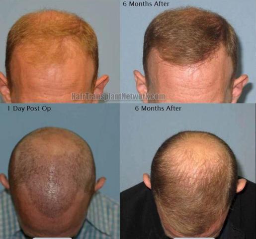 Hair transplantation surgery before and after photos,