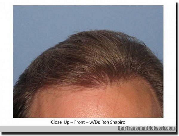 Hair restoration procedure results