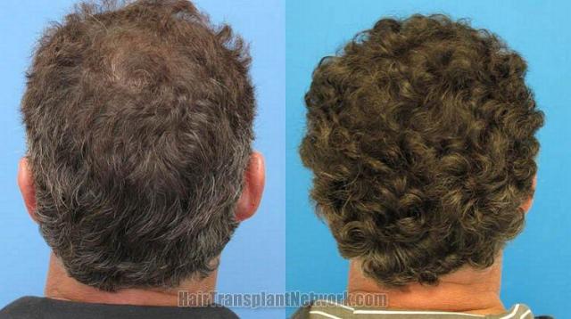 Hair restoration procedure results