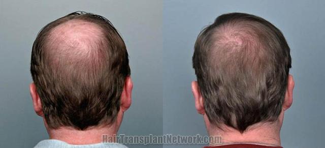 Hair restoration procedure before and after pictures