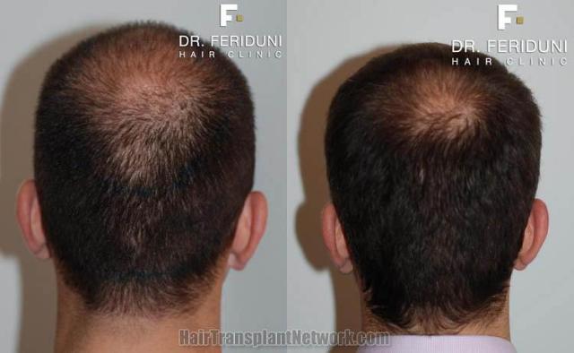 Back view before and after hair transplantation photos