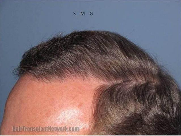 Photo showing closeup of hairline 10 months postoperative