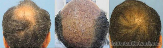 Crown view of hair transplant patient's results