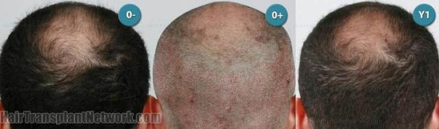 Hair restoration procedure before and after pictures