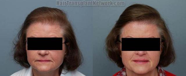 Female  before and after photos