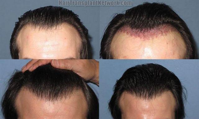 Hair transplant photos viewed from the front