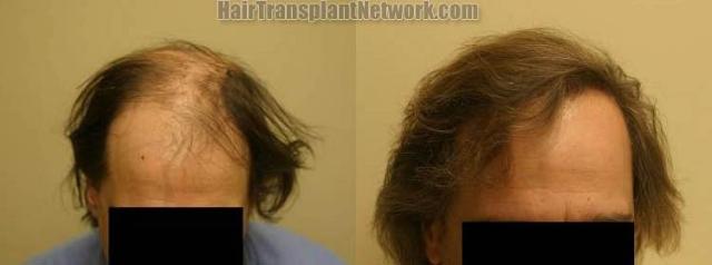 Before and after hair restoration photos