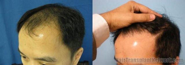 Hair restoration results after 10 months