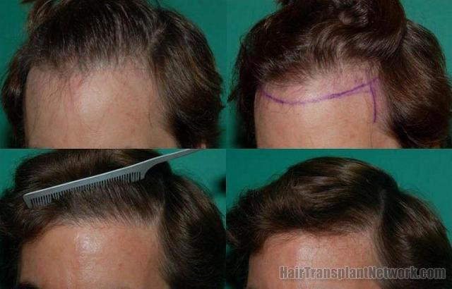 Hair restoration pictures showing left angle before and after