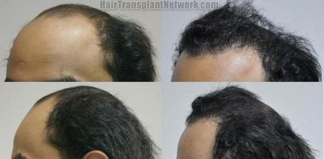 Hair transplantation surgery before and after images