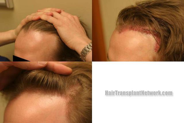 Hair restoration procedure before and after pictures