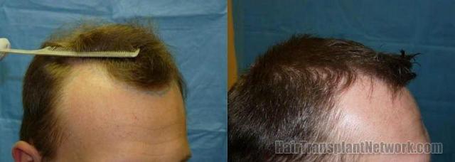 Hair restoration procedure - right side photos