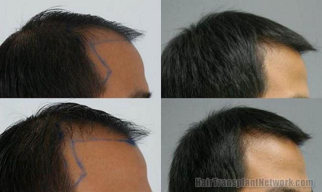 Thailand hair restoration procedure results