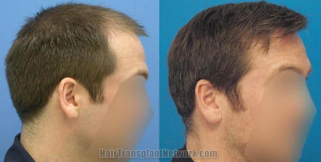 Hair restoration procedure before and after results