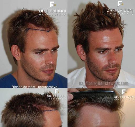 Hair transplantation surgery before and after photos