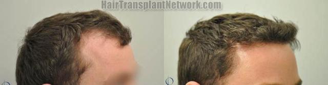 Hair transplantation surgery before and after images