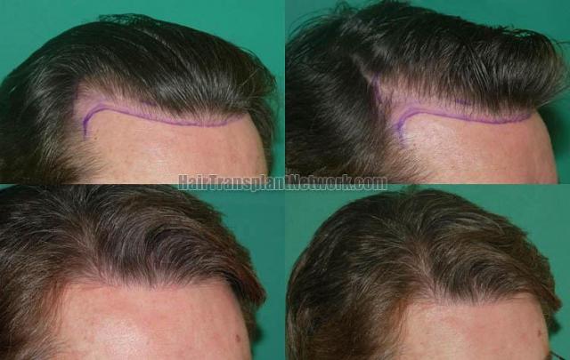 Dr Raymond Konior Hair Restoration Procedure Before And After Images