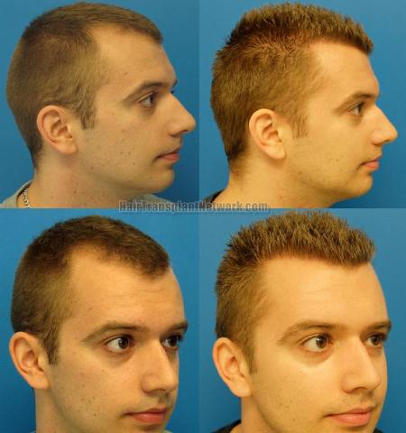 Hair transplantation surgery before and after images