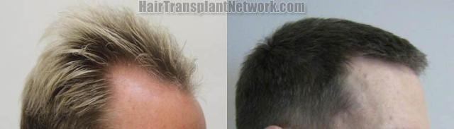 Hair transplantation surgery before and after pictures