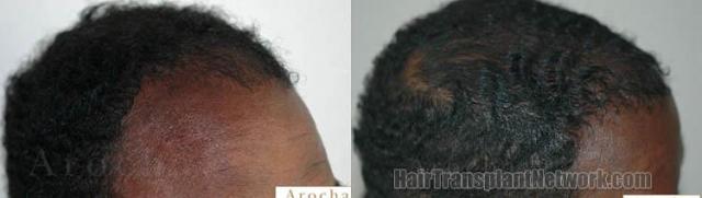 Hair restoration procedure before and after results