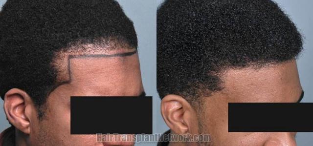 Hair transplantation surgery before and after photos