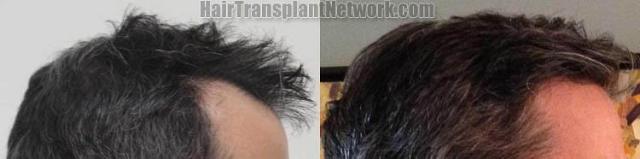 Hair transplantation surgery before and after images