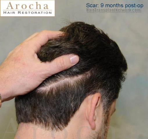 Surgical hair transplantation result photographs