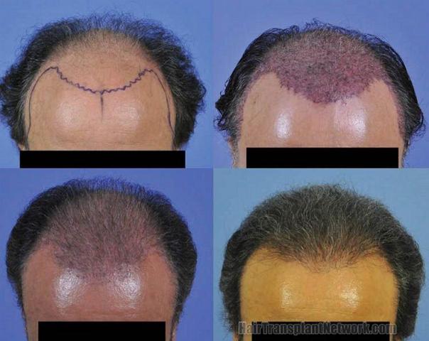 Tilt down angle view of hair replacement surgery