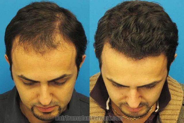 Hair restoration surgery before and after photos