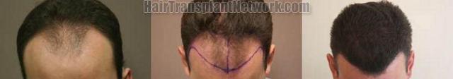 Top view showing hair restoration results